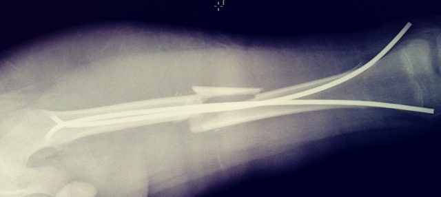 X ray of broken leg and flex nails.